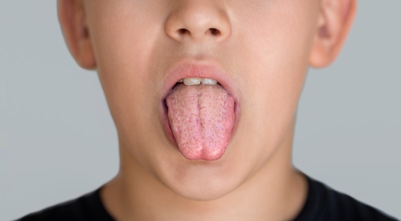 Obraz może przedstawiać objawy grzybicy jamy ustnej u dziecka, co jest infekcją wywołaną przez drożdżaki Candida. Objawy to białe plamy na języku i wewnętrznych stronach policzków. Ważne jest, aby skonsultować się z pediatrą w celu uzyskania odpowiedniego leczenia, które może obejmować leki przeciwgrzybicze. Dbanie o higienę jamy ustnej jest również kluczowe.